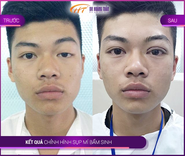 Kết quả sửa sụp mí tại Thẩm mỹ Hoàng Tuấn